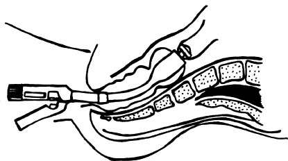 PDF) Obliteração do reto e canal anal como complicação da  retossigmoidectomia anterior com anastomose colorretal baixa: relato de caso