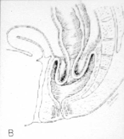 PDF) Obliteração do reto e canal anal como complicação da  retossigmoidectomia anterior com anastomose colorretal baixa: relato de caso